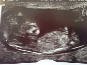 12 Week scan picture